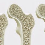 Osteoporosi: prevenzione naturale attraverso l’alimentazione