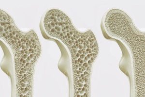 Osteoporosi: prevenzione naturale attraverso l’alimentazione