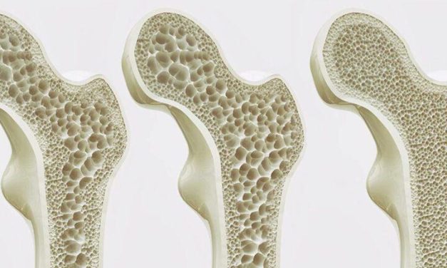 Osteoporosi: prevenzione naturale attraverso l’alimentazione